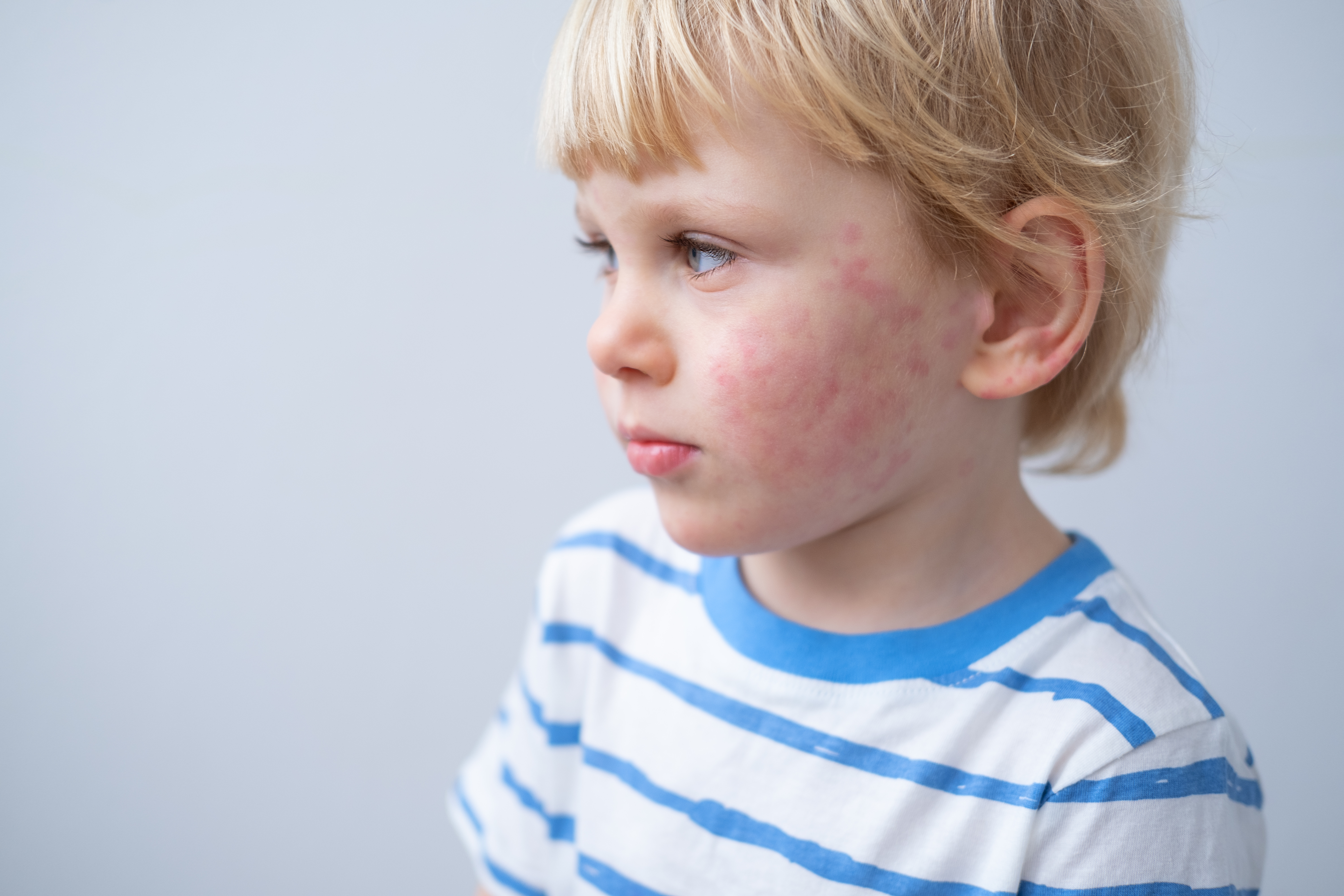 Skin rash Causes